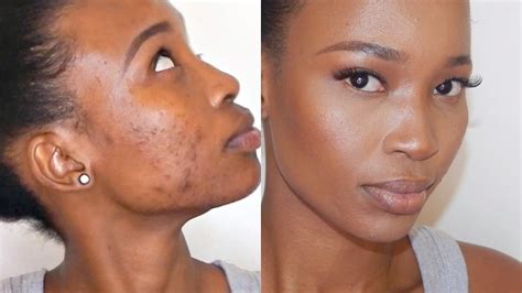 Flawless Full Coverage Foundation Routine Acne Scar Coverage Youtube