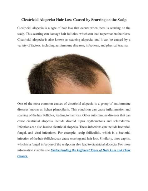 Ppt Cicatricial Alopecia Powerpoint Presentation Free Download Id