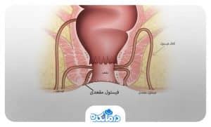 فیستول چیست علت درمان جراحی و علائم