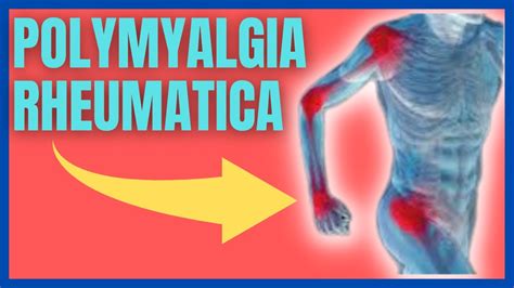 What Is Polymyalgia Rheumatica Symptoms Causes Treatments YouTube