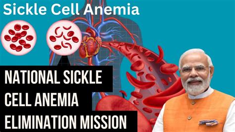 Sickle Cell Anemia National Sickle Cell Anemia Elimination Mission