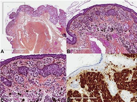 Figure From Molecular Analysis Of Melanocytic Naevus Arising From