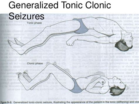 Types Of Seizure