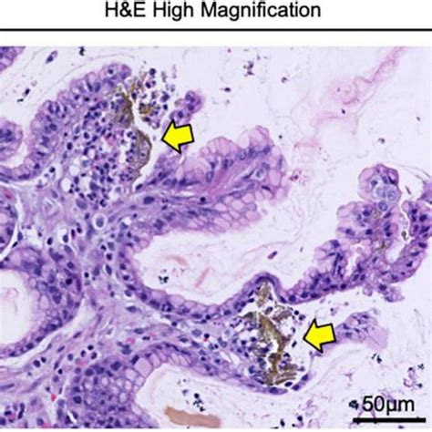 Gastric Biopsy Confirming The Diagnosis Of Iron Pill Gastritis Gastric Download Scientific