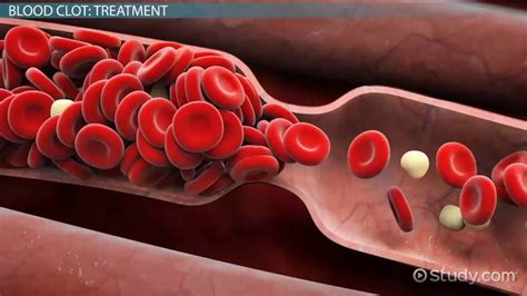 Blood Clot In The Foot Overview Symptoms And Treatment Lesson