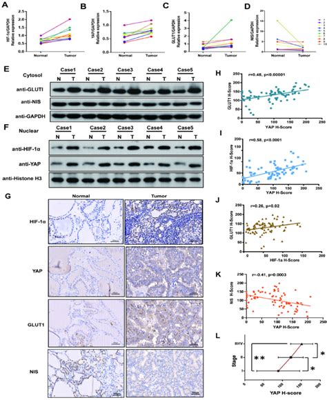 YAP Expression Was High In PTC Tissues And Correlated Strongly With