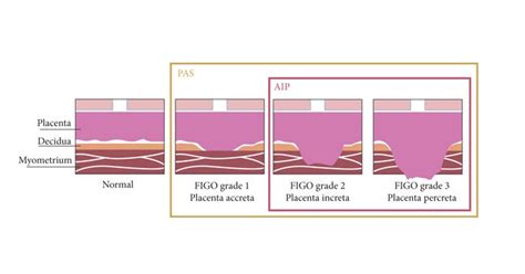 Spp And Figo Grading Systems For Placenta Accreta Spectrum Medicalkidunya