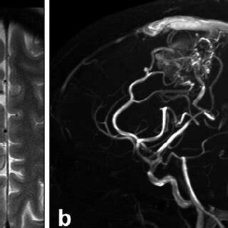 Three Dimensional Phase Contrast Mr Angiography Pc Mra Maximum