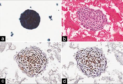 Greater Specificity Of P40 Compared With P63 In Distinguishing Squamous