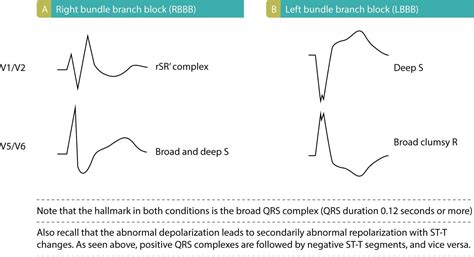 Figure 3. This figure illustrates ECG patterns in LBBB and RBBB. As seen, LBBB is characterized ...