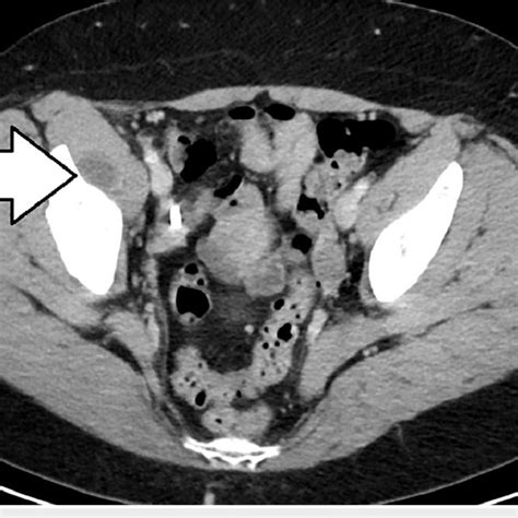 Ct With Contrast Coronal Image With Right Sided Iliopsoas Bursitis