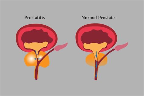 Premium Vector Comparation Of Health Prostate And Unhealth Prostate