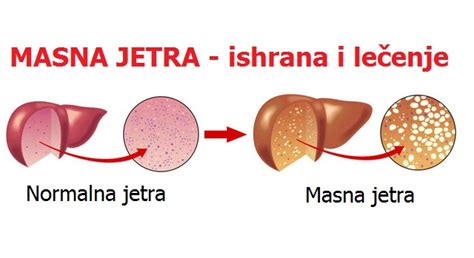 Masna Jetra Simptomi Ishrana I Prirodno Lečenje