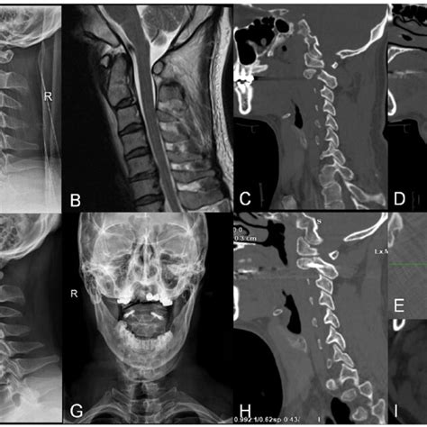 A The Preoperative Lateral Radiograph Of A Year Old Male Patient