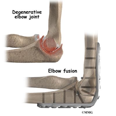 Elbow Fusion Eorthopod