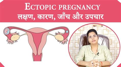 Ectopic Pregnancy In Hindi Causes Signs Symptoms Treatment Dr