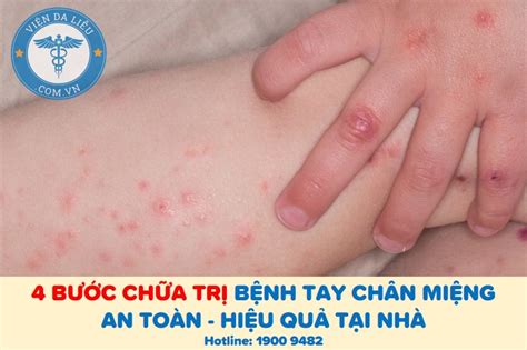 4 Bước Chữa Trị Tay Chân Miệng An Toàn Hiệu Quả Tại Nhà