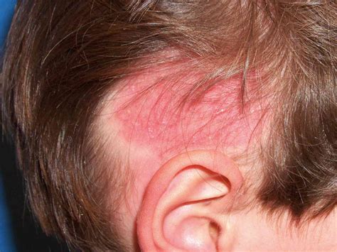 Causes Of Red Spots On Your Scalp And How To Treat Them