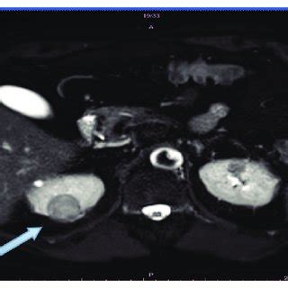 Preoperative axial contrast-enhanced MRI scan of abdomen showing 4.5-cm... | Download Scientific ...