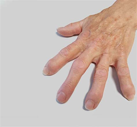 Schwerpunkt Psoriasispsoriasis Arthritis Rheuma Schweiz