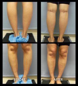 before-after-calf-implants-15 | Gravity Medical Spa