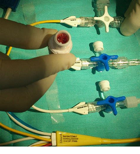 Figure 1 From Should High Thoracic Epidural Analgesia Be Dismissed In