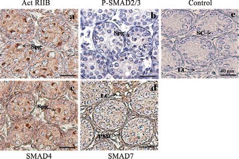 Immunohistochemical Results Of Actriib Phospho Smad23 Smad4 And