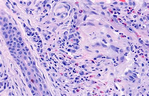 Pathology Outlines Granuloma Faciale