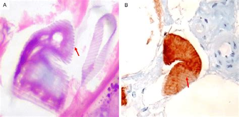 A Sequential Embryoid Like Metamorphosis Step Hypertrophic