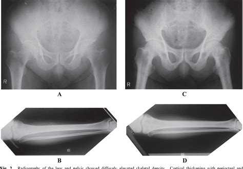 Figure From A Case Of Hepatitis C Associated Osteosclerosis In An