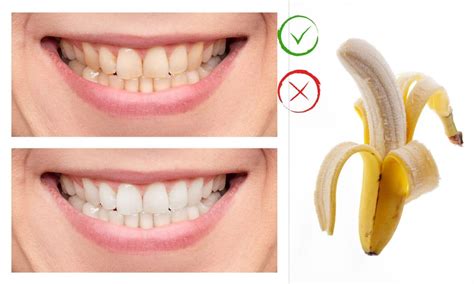 Casca De Banana Clareia Os Dentes Descubra Se Mito Ou Verdade Sa Delab