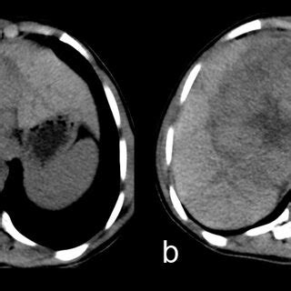 Coupes Axiales D Une Tomodensitom Trie Abdominale Avant Injection De