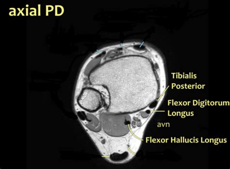 Axial MRI Anatomy Flashcards | Quizlet