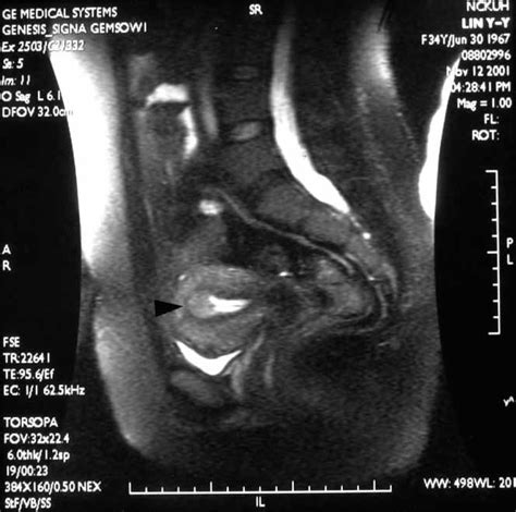 Threedimensional Transvaginal Ultrasound Provides Clearer Delineation