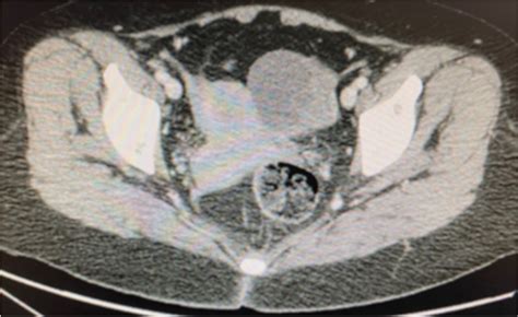 Abdominopelvic Ct Scan Showing The Above Described Solid Cystic