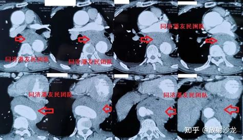 典型影像图解：主动脉夹层的7种死法！ 知乎