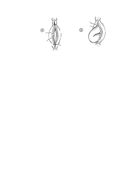 Figure 4 1 Wound Separations A Dehiscence B Evisceration