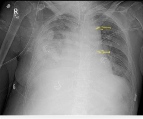 Central Venous Line Placement