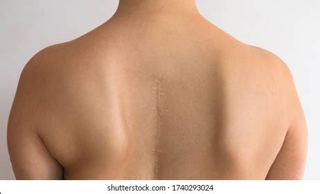 Pain Between Shoulder Blades Photos Images Pictures Shutterstock