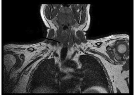 MRI suggested edema with thickening and continuity of C5, C6 & C7 roots... | Download Scientific ...