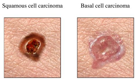 Basal Cell Carcinoma What Is Bcc Causes Treatments And More