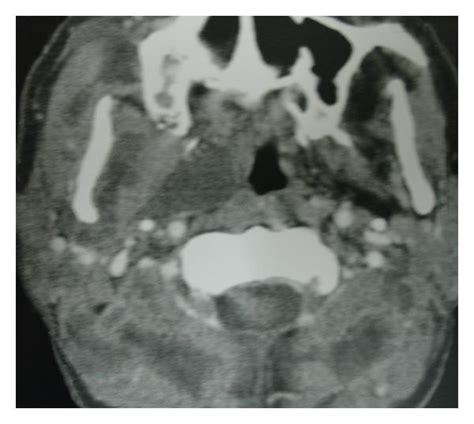 Neck Ct Scan Of The Case Shows Multiple Cystic Lesions In The Neck And Download Scientific