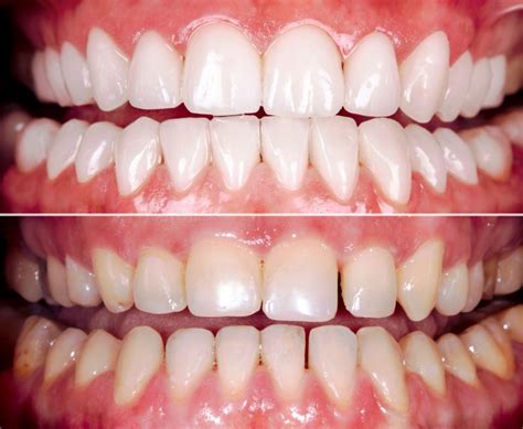 Teeth Whitening Leicester Manor Dental Centre