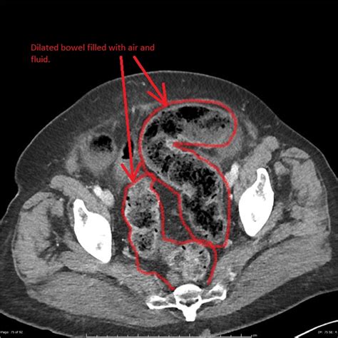 Ischemic colitis CT - wikidoc