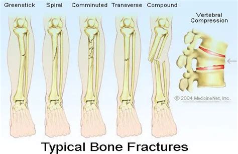 broken bones fractures types symptoms treatment surgery