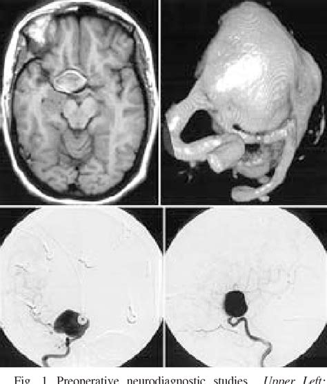 Figure From Selective Cerebral Revascularization As An Adjunct In The