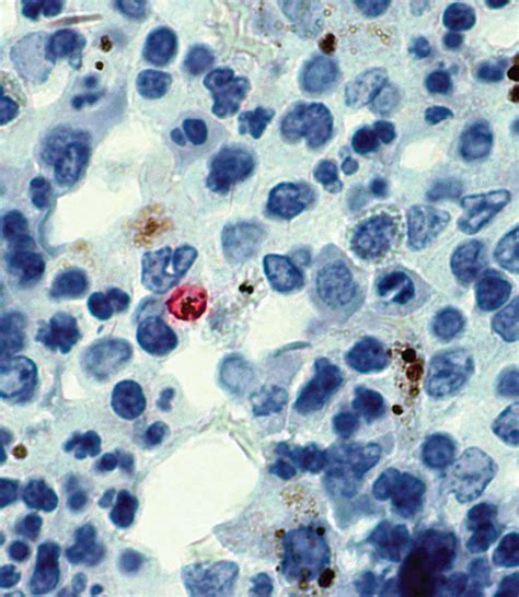 Targeting Malaria Parasites That Hide In Bone Marrow Allergy And