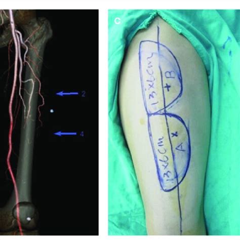 Comparison Between Preoperative And Intraoperative Body Surface