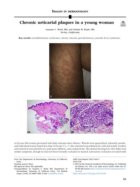 Pdf Chronic Urticarial Plaques In A Young Woman