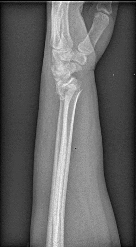 Fracturas De Radio Distal En Nuestro Hospital Ocronos Editorial